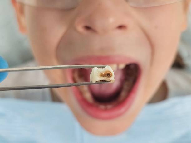 Best Emergency Treatment for Toothache in Superior, CO